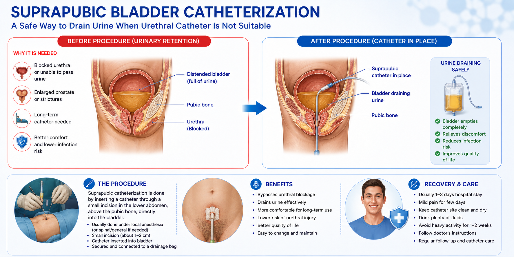Suprapubic Catheterization